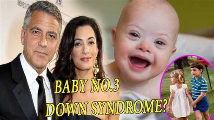 George Clooney's Child And Down Syndrome